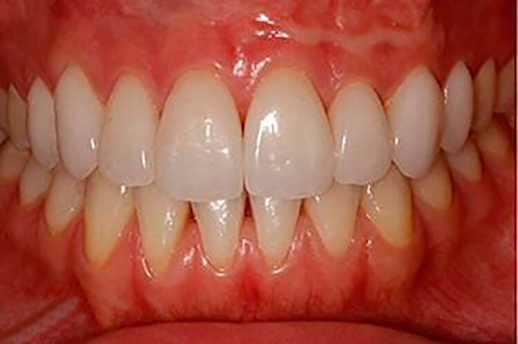 carillas-de-porcelana-despues