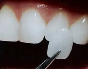 carilla dental clinica Birbe