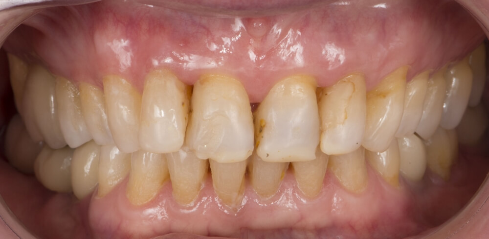 Rejuvenecimiento dental pre tratamiento - Clínica Birbe