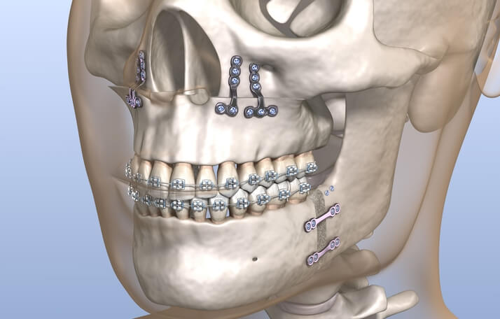 Ortodoncia quirúrgica - Clínica Birbe