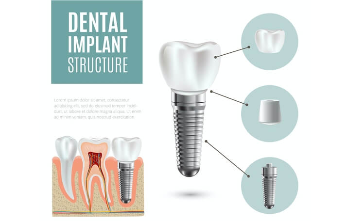 implantes dentales Barcelona